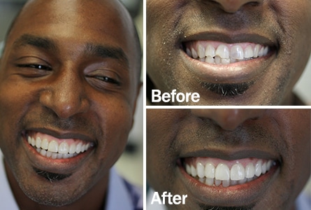 porcelin veneers before after