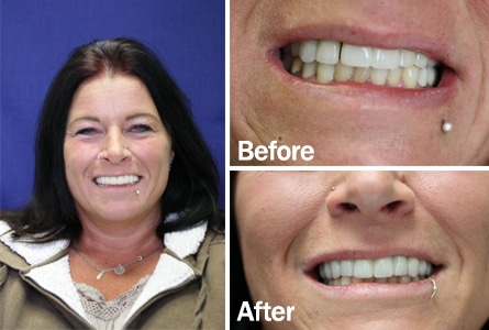 smile makeover before after