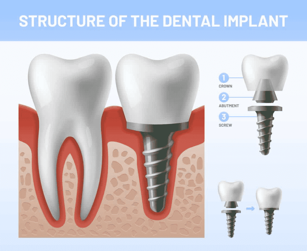 dental implant new