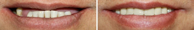 All-On-Four Before and After Photos in Houston, TX, Patient 7672