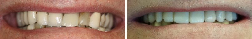 Full Mouth Reconstruction Before and After Photos in Houston, TX, Patient 7684