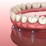 Can All-on-4® Replace All My Teeth in One Day?
