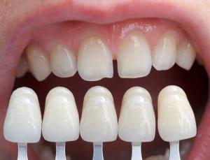 Porcelain veneers are made to match your teeth color