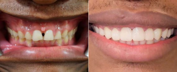 Veneers Before and After Photos in Houston, TX, Patient 8487