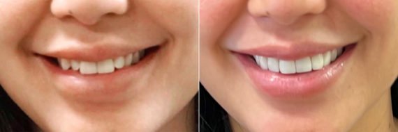 Veneers Before and After Photos in Houston, TX, Patient 8510