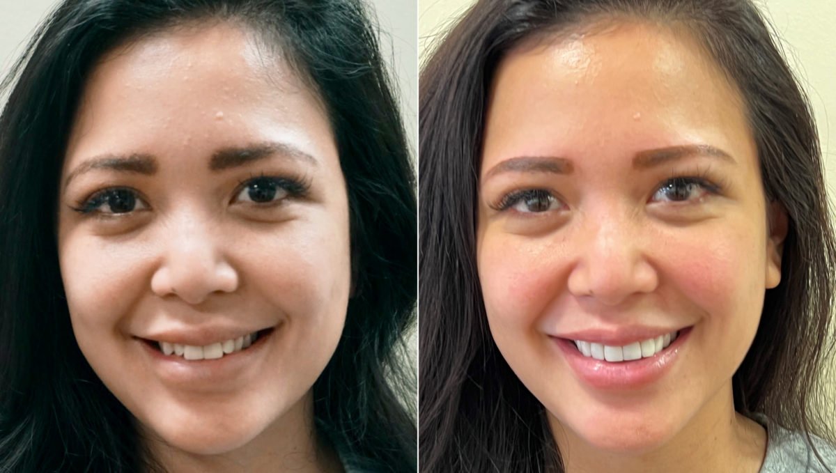 Veneers Before and After Photos in Houston, TX, Patient 8510
