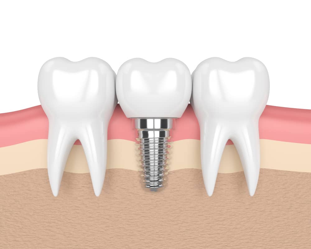 AAOMS confirms that dental implants are frequently the best choice for replacing missing teeth. 