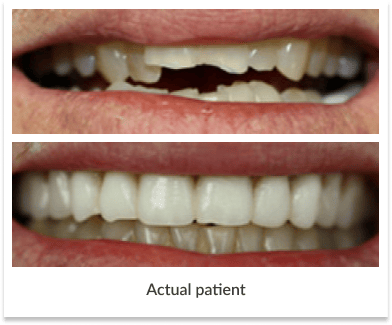 Dental Implants actual patient
