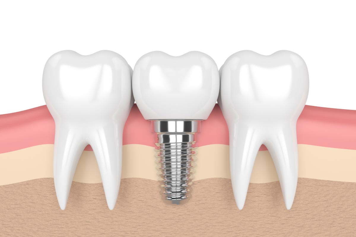 How Long Do Dental Implants Last?