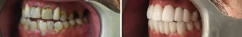 Crowns Before and After Photos in Houston, TX, Patient 8871