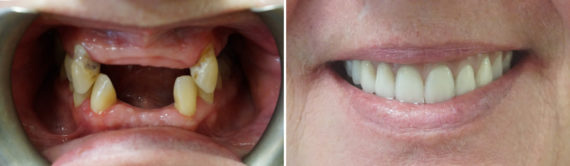 All-On-Four Dental Implants Before and After Photos in Houston, TX, Patient 8764