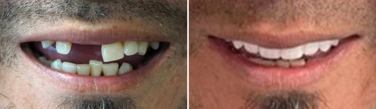 All-On-Four Dental Implants Before and After Photos in Houston, TX, Patient 8912