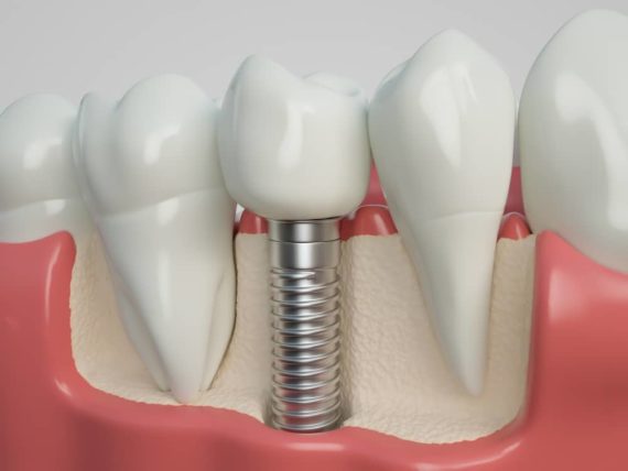 5 Facts About The Dental Implant Recovery Process Houston