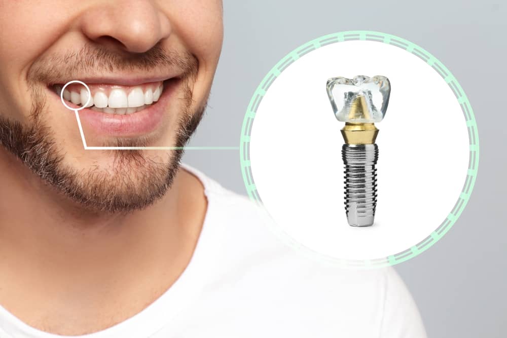 It's completely normal that metal shows after a dental implant. As the healing process takes place, the screw will disappear in the gum.