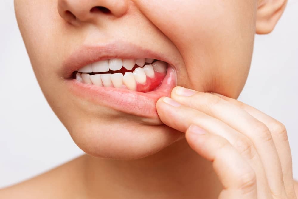 Having red, swelling or bleeding gums are a sign of implant failure and infection. It is necessary to contact your oral surgeon as soon as possible