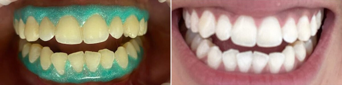 Teeth Whitening Before and After Photos in Houston, TX, Patient 8780