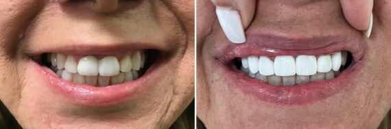 Veneers Before and After Photos in Houston, TX, Patient 9172