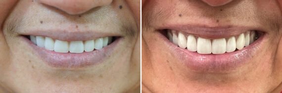 All-On-Four Dental Implants Before and After Photos in Houston, TX, Patient 9178