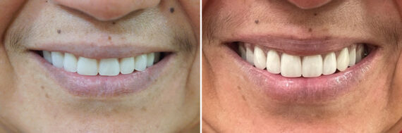 All-On-Four Dental Implants Before and After Photos in Houston, TX, Patient 9178