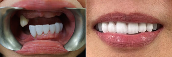 All-On-Four Dental Implants Before and After Photos in Houston, TX, Patient 9022