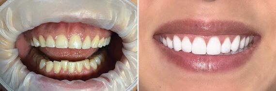 Veneers Before and After Photos in Houston, TX, Patient 9353