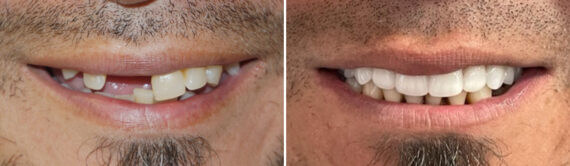 All-On-Four Dental Implants Before and After Photos in Houston, TX, Patient 8912