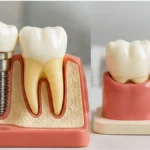 On-Site Dental Lab for Crowns and Implant Restorations Dental crown, bridge, and implant restoration models representing an on-site dental laboratory in Houston